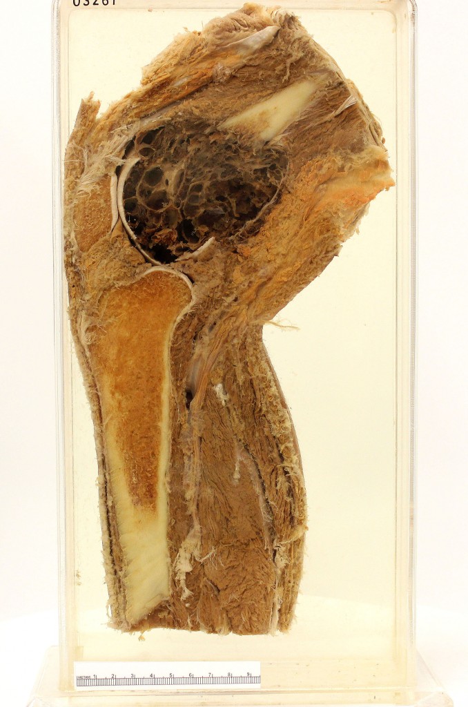 Sagittal section of knee (distal femur and proximal tibia)